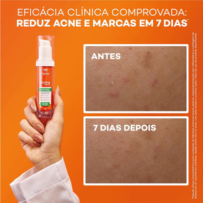 Concentrado Renovador Antiacne 30g (Ácido Succínico 3%, Niacinamida 4%)